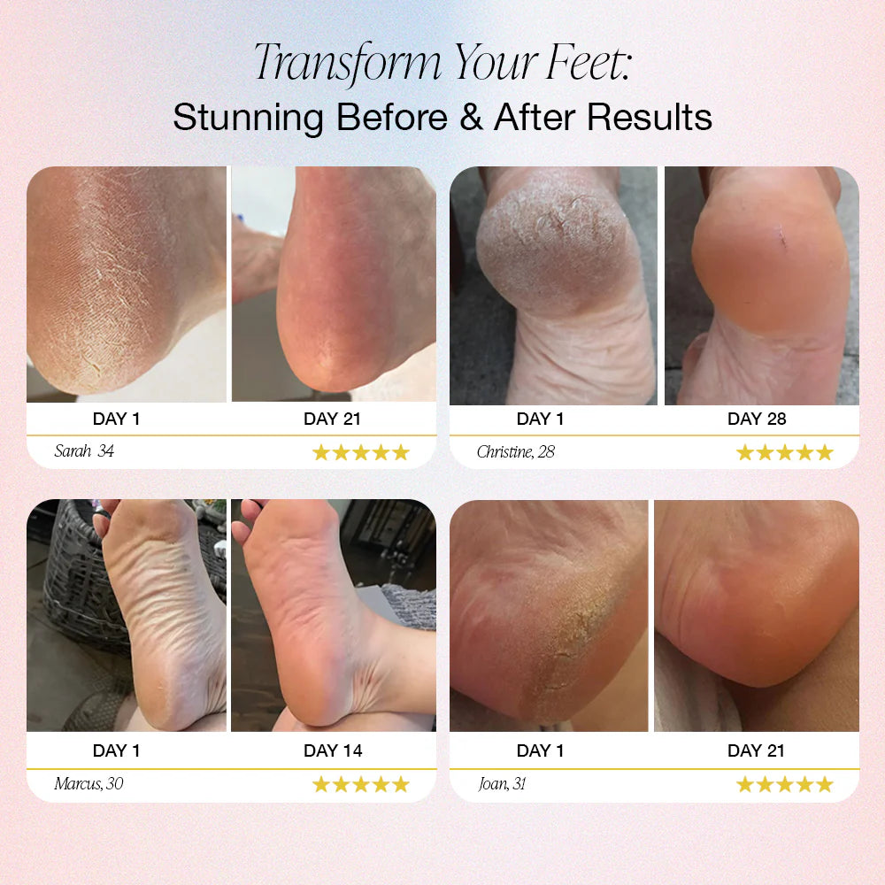 SmoothStep™ Foot care New Electric Callus Remover